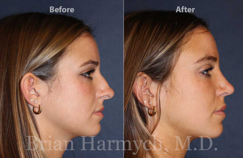 Rhinoplasty1_Profile right 1